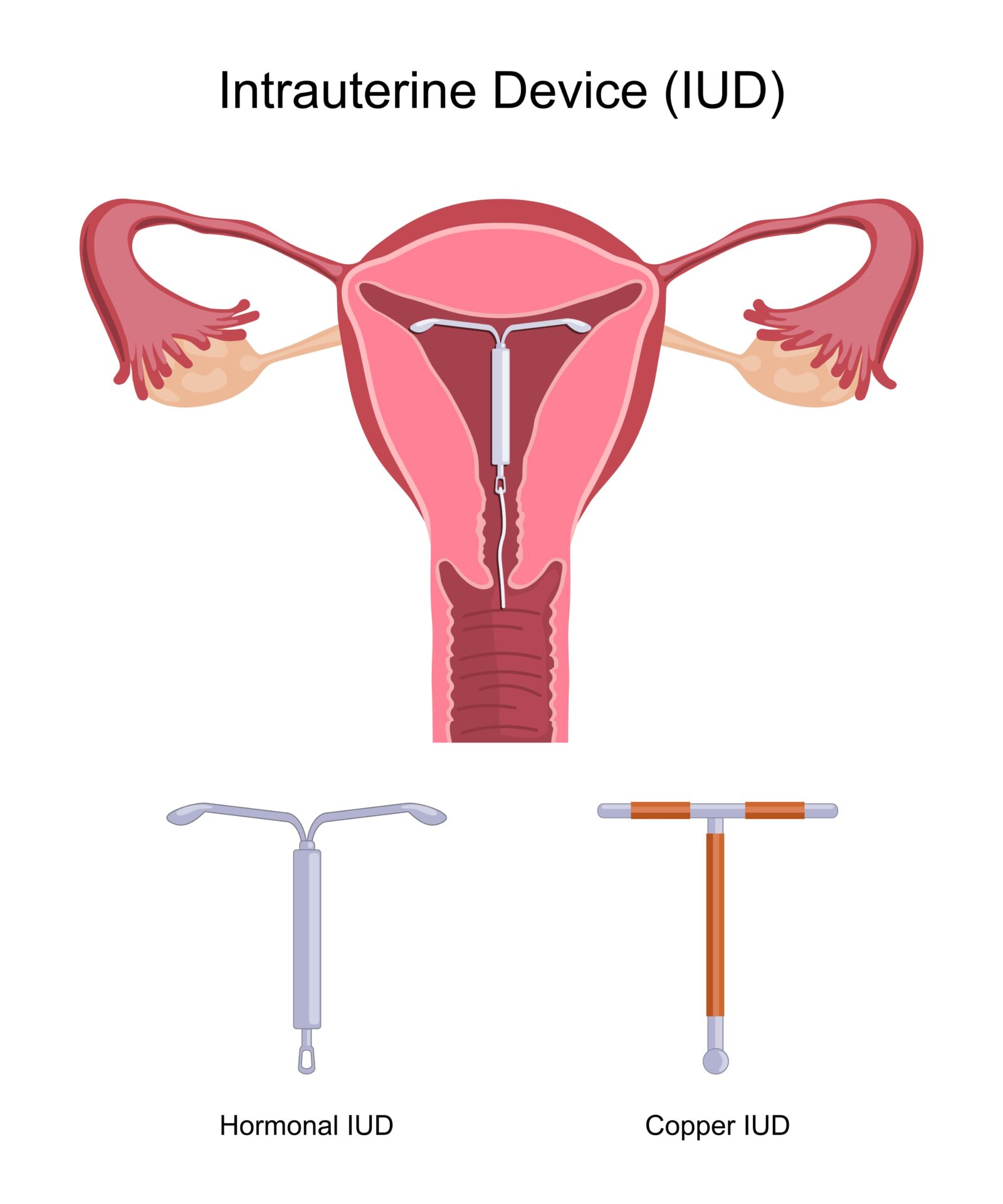 diferentes tipos de dispositivos intrauterinos (DIU)