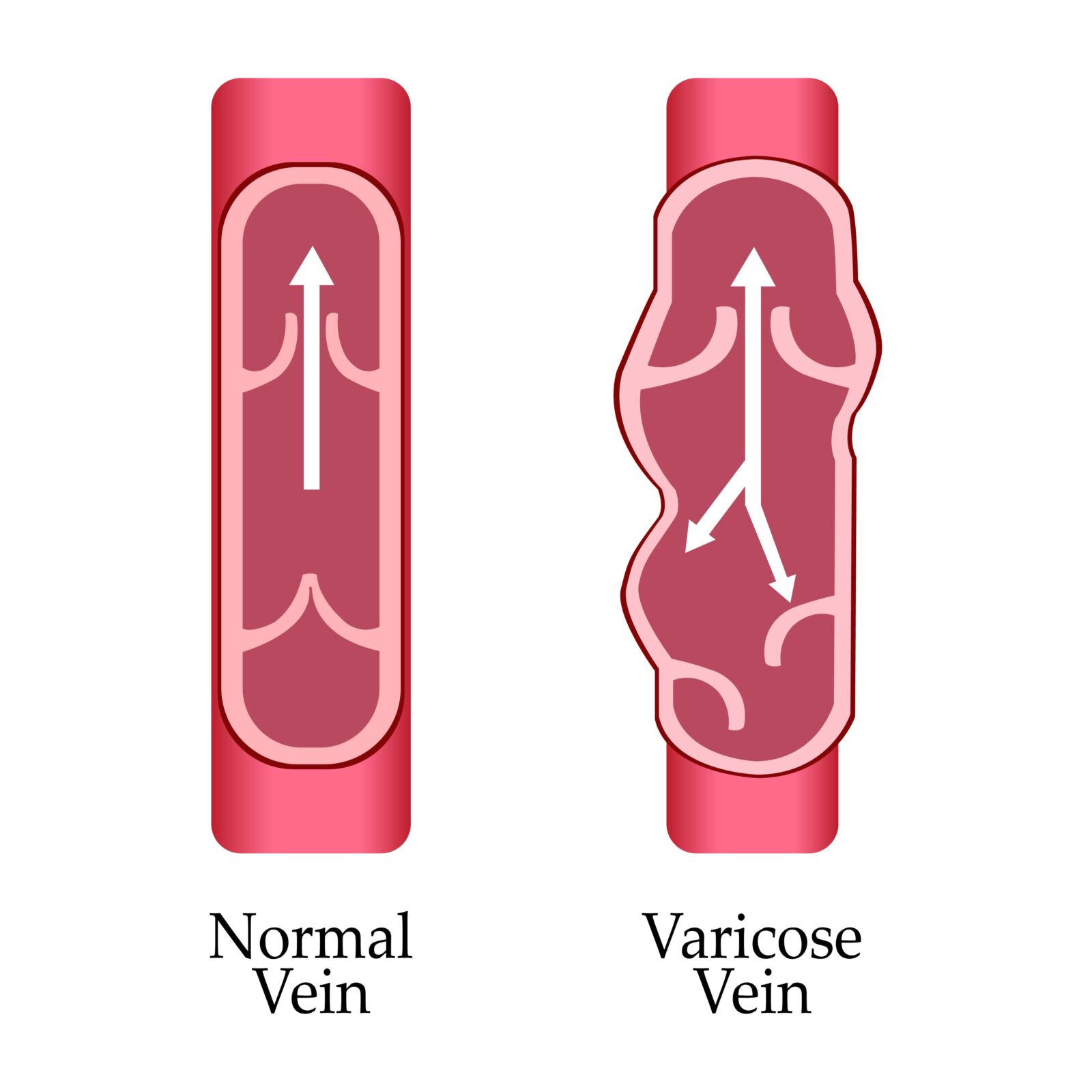 vena normal frente a vena varicosa