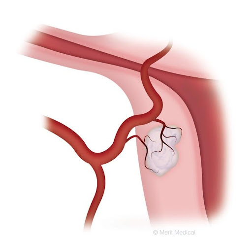 uterine artery