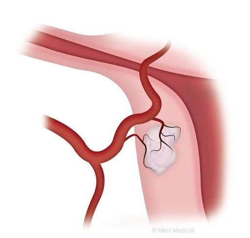 uterine artery