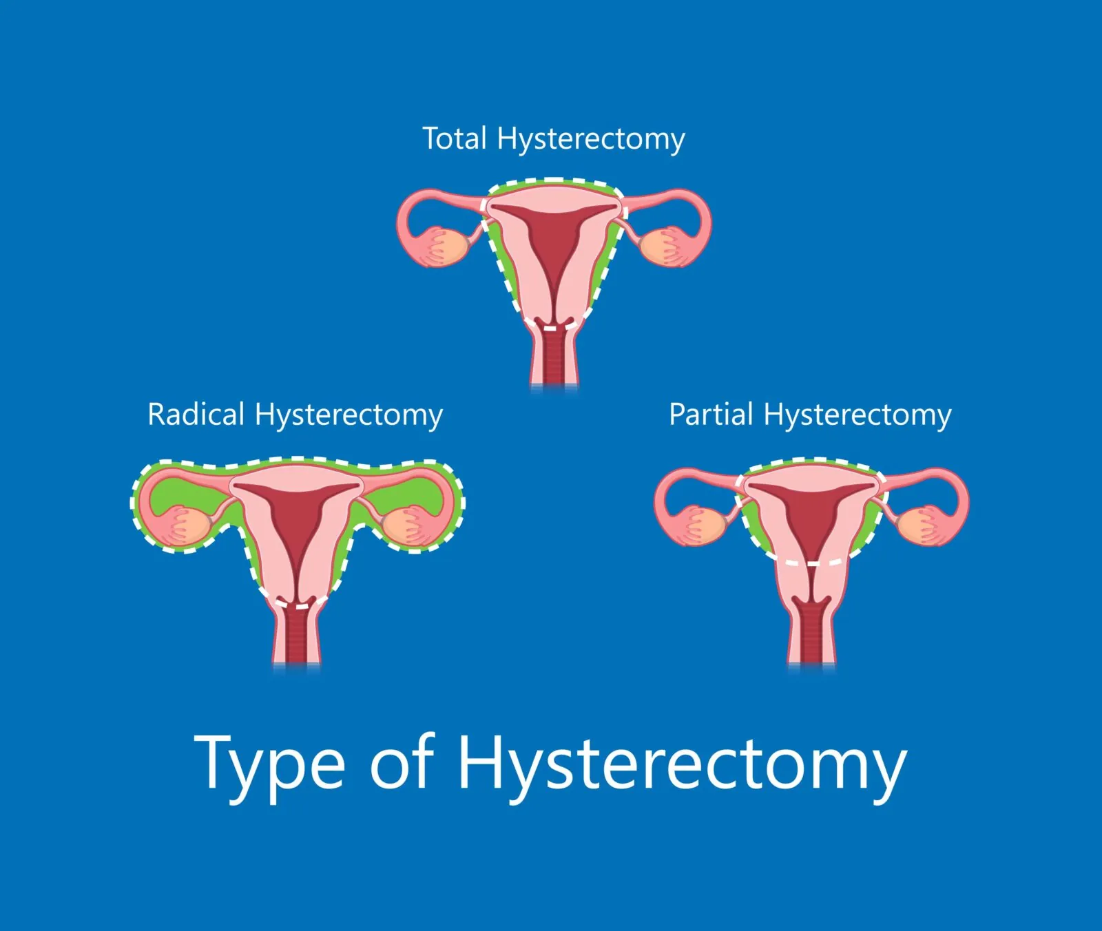 types of hysterectomy