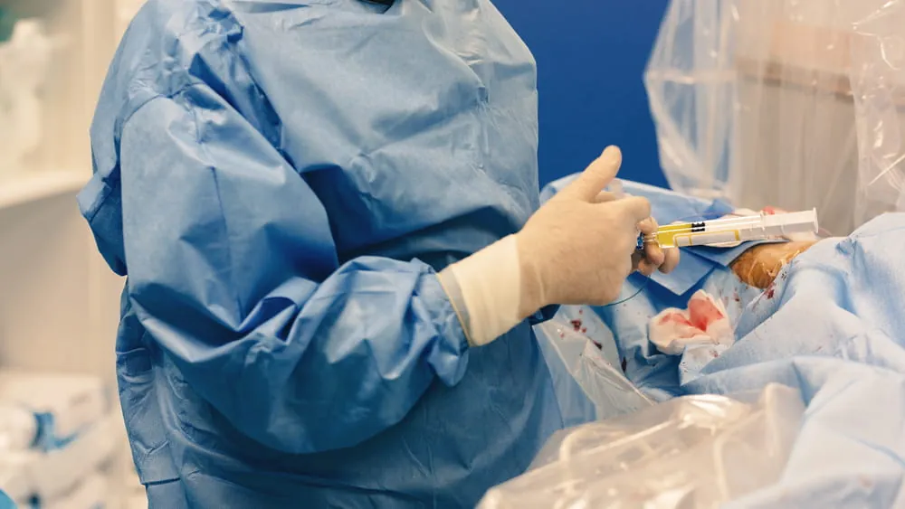 Uterine fibroid embolization procedure by an interventional radiologist blocks blood flow to fibroids in the uterus called uterine artery embolization