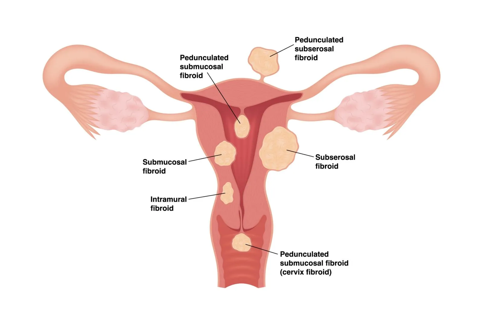 types of fibroids