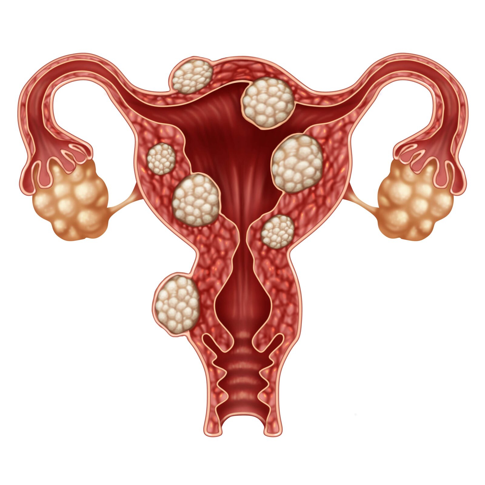miomas uterinos