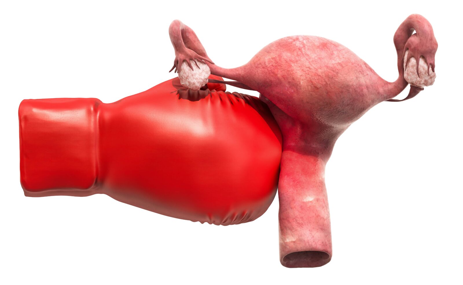 guante de boxeo golpeando un útero gigante para indicar dolor