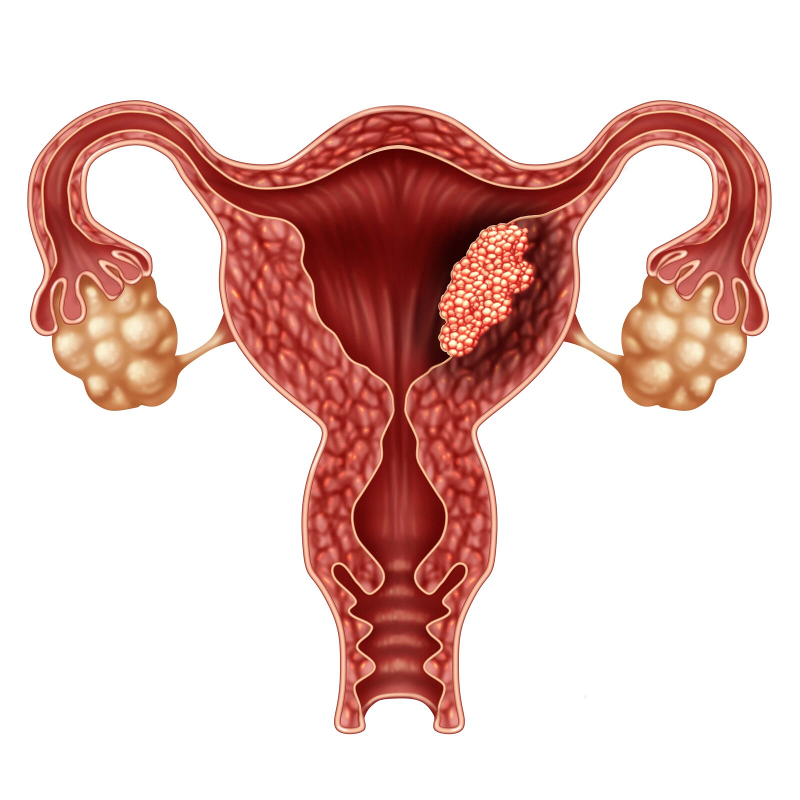 Cáncer de útero