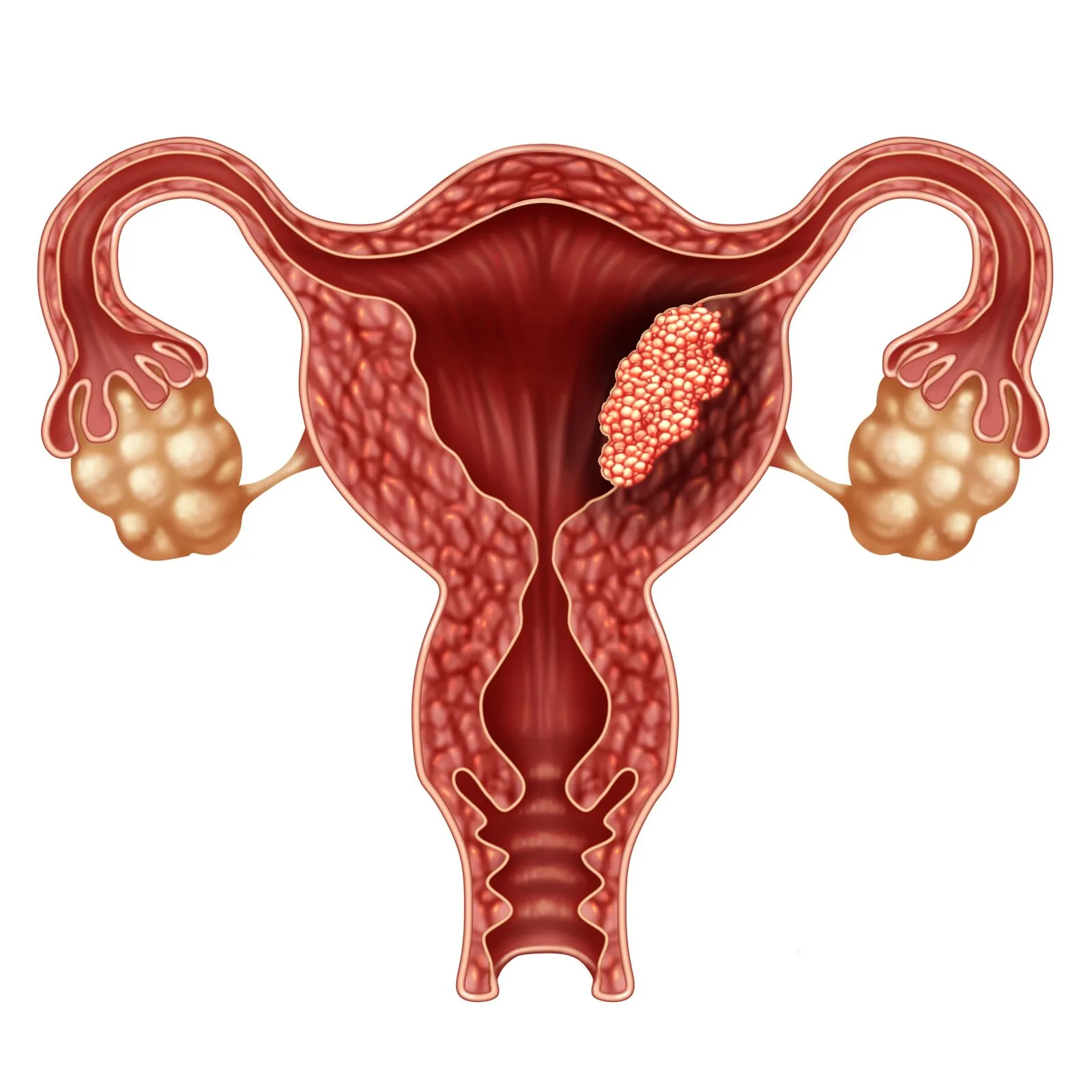 Uterine Cancer