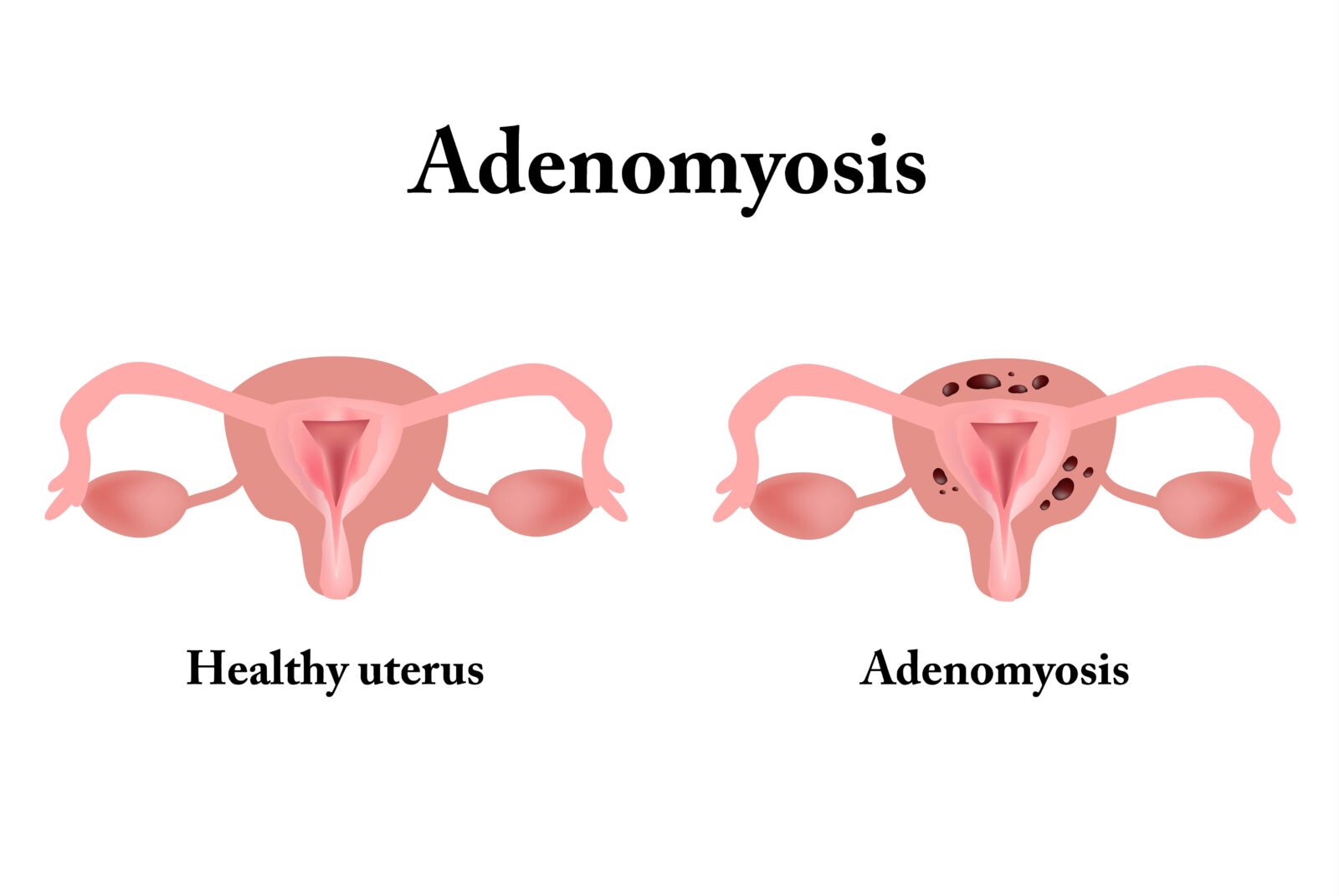 adenomiosis