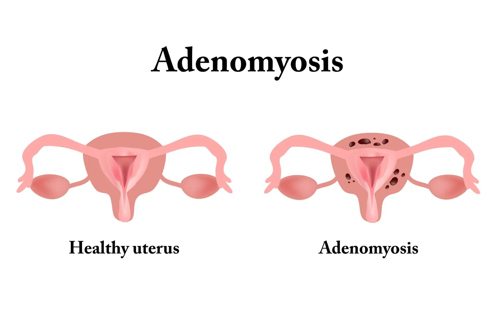adenomyosis