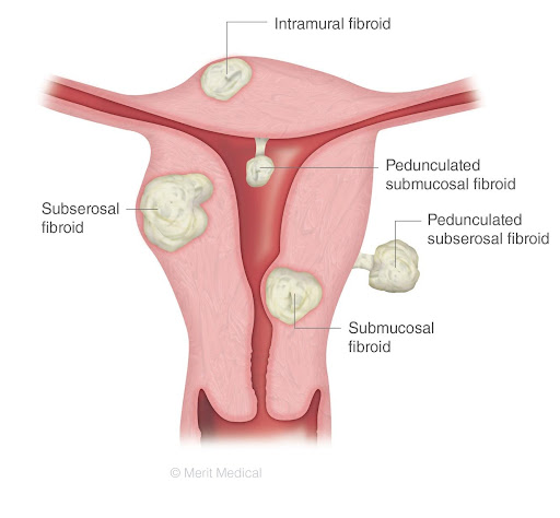 miomas