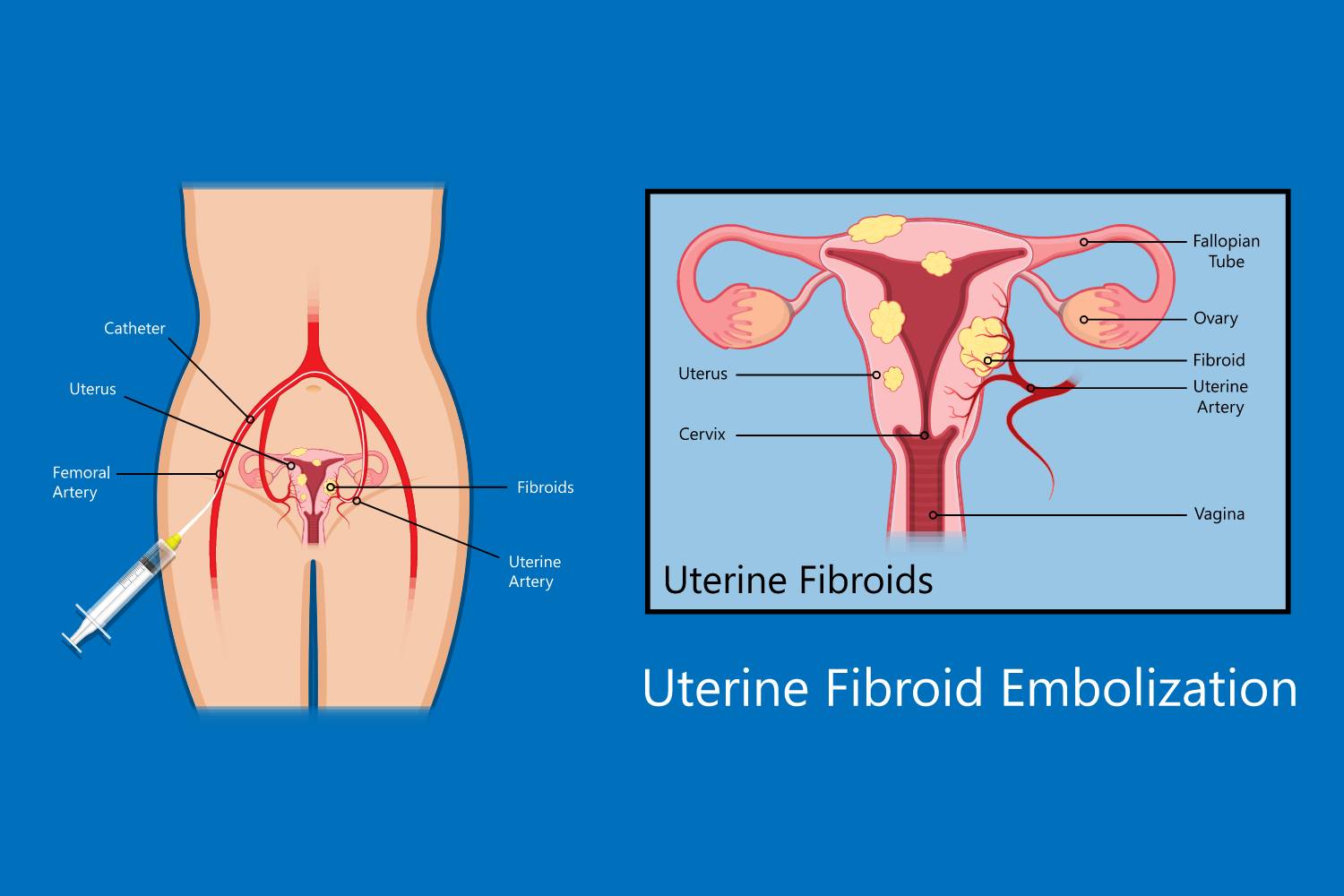 fibroids removal surgery