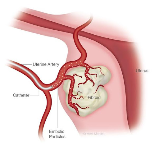 uterine artery