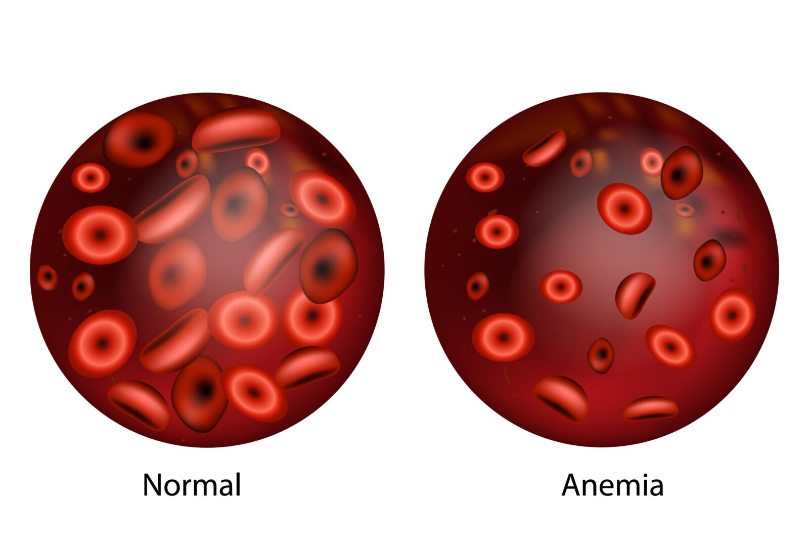 normal blood vs. anemic blood