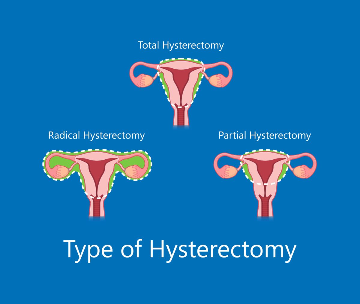 Myomectomy Vs. Hysterectomy: Which Is Right For You? | New York City ...