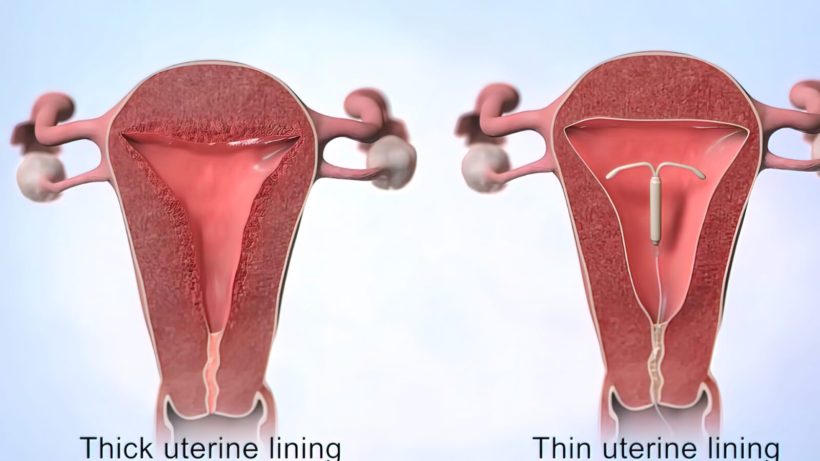 thick vs thin uterine lining with IUDs