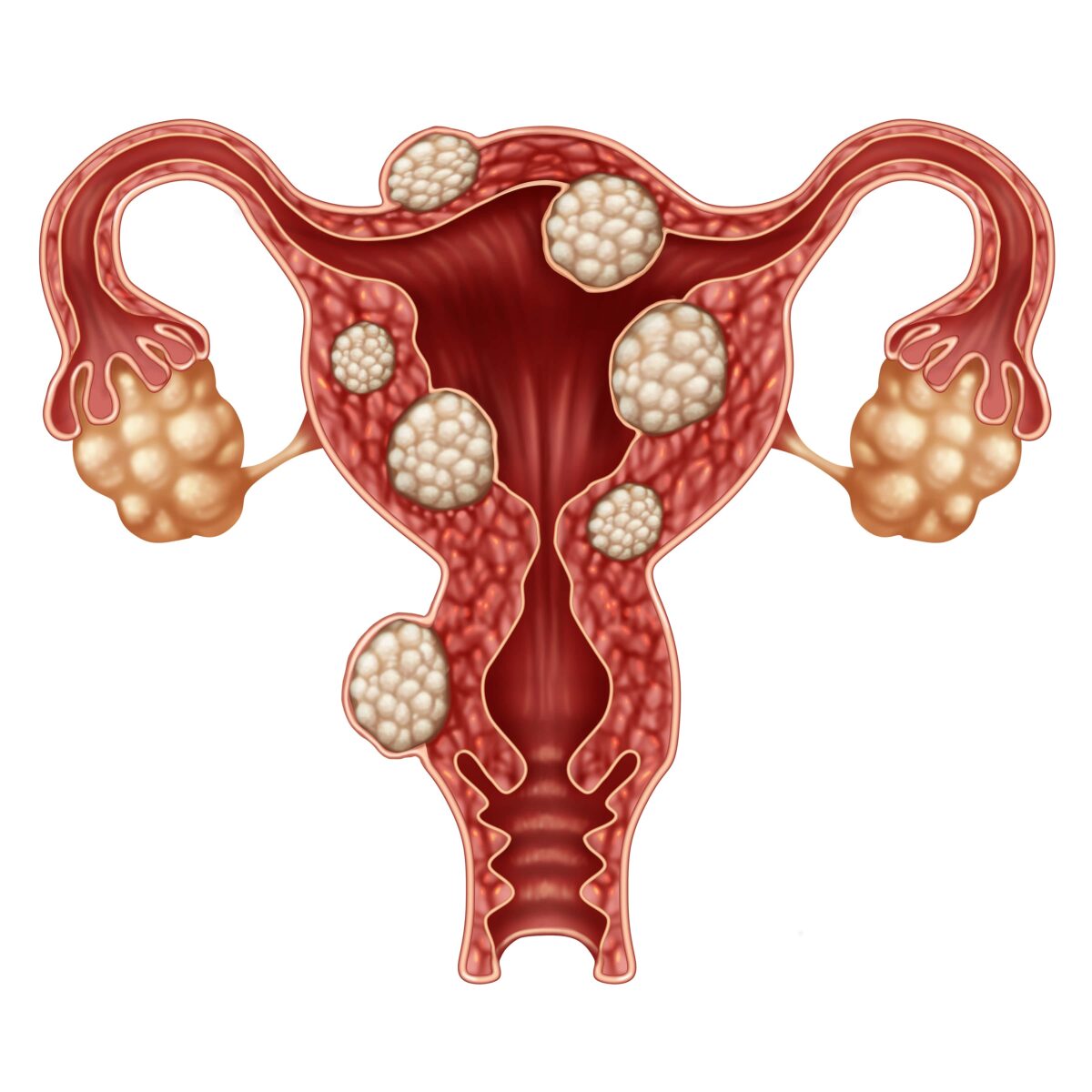 Fibroids Vs Cysts Whats The Difference New York City 1 Fibroid Center