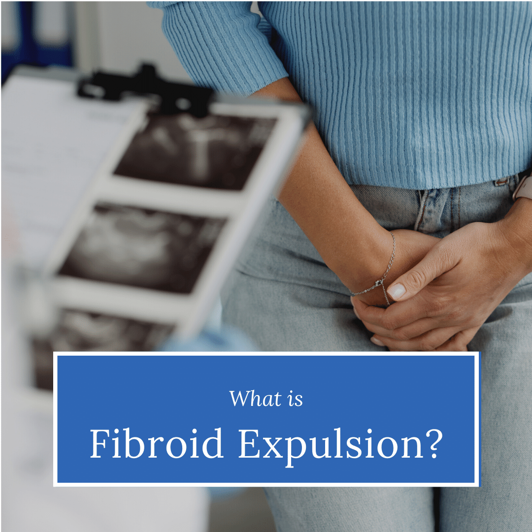 What is Fibroid Expulsion