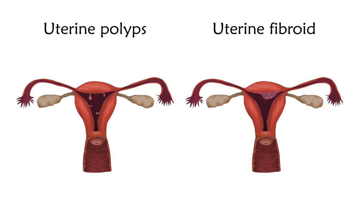 Fibroids Vs Polyps Whats The Difference New York City 1 Fibroid Center 5524