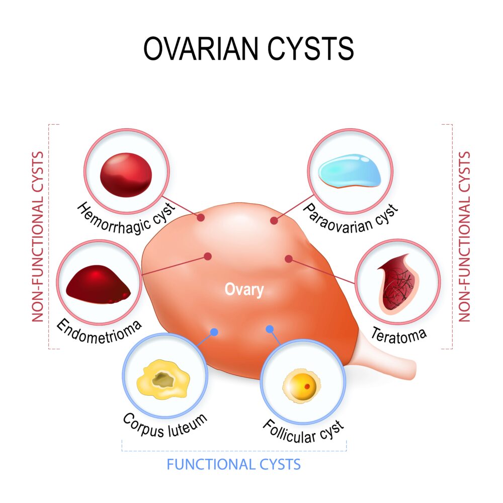 Fibroids Vs Cysts Whats The Difference New York City 1 Fibroid Center